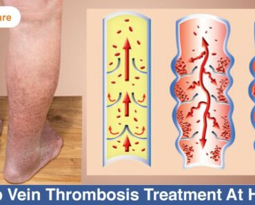 Deep Vein Thrombosis: 10 Proven Natural Home Remedies