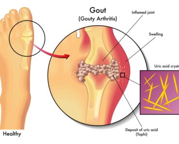 Gout: Best Home Remedies and Lifestyle Changes