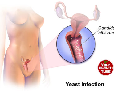 Yeast Infection: 6 Effective Natural Home Remedies