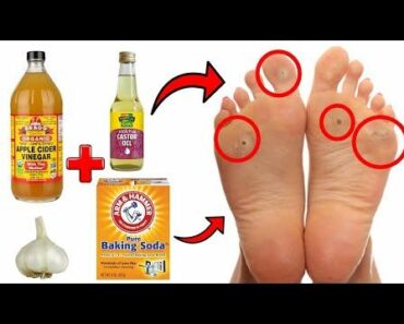 How To Cure Corns and Calluses Naturally