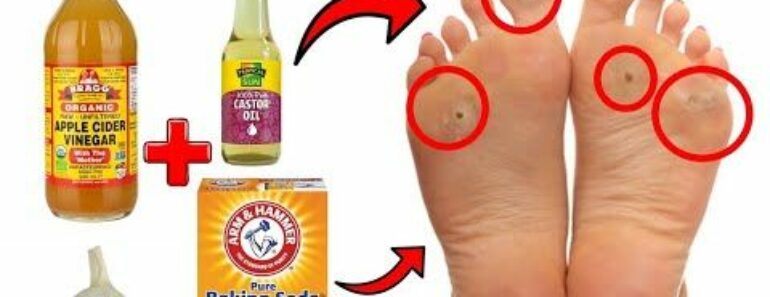 How To Cure Corns and Calluses Naturally