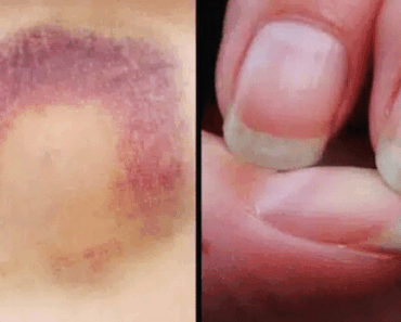 15 Silent Cancer Symptoms Every Woman Should Know – Early Detection Saves Lives