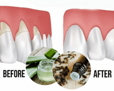 Here Is How To Grow Back Your Receding Gums With The Following Home Remedies
