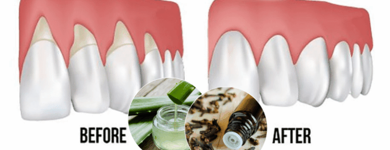 Here Is How To Grow Back Your Receding Gums With The Following Home Remedies
