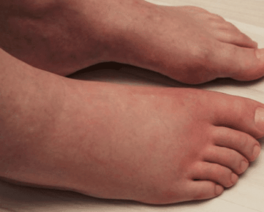 Scientists Explain 6 Things That Can Cause Swollen Legs (And How to Treat It)