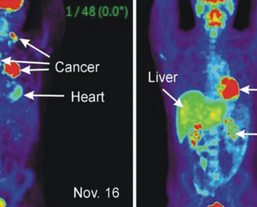 10 Warning Signs That Anounce Cancer May Be Growing in Your Body