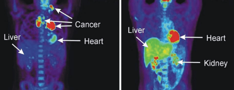 10 Warning Signs That Anounce Cancer May Be Growing in Your Body