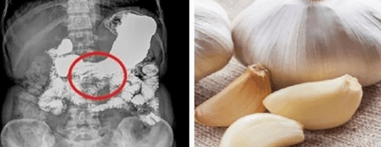 Here’s What Happens When You Eat Raw Garlic on an Empty Stomach Every Day — It’s Wild!