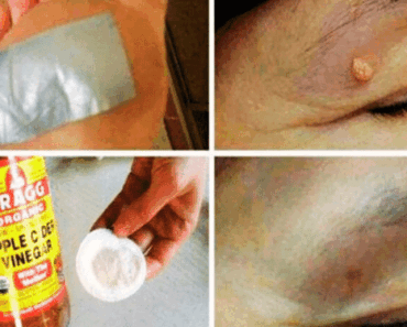 Erase Warts, Dark Spots, Blackheads & Skin Tags FAST With These Simple Home Remedies!