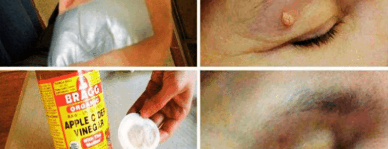 Erase Warts, Dark Spots, Blackheads & Skin Tags FAST With These Simple Home Remedies!