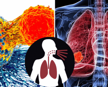 Early Warning Signs and Symptoms of Lung Cancer You Shouldn’t Ignore