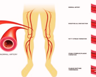 7 Natural Hacks to Instantly Clear Your Arteries – No Pills, Just Results!