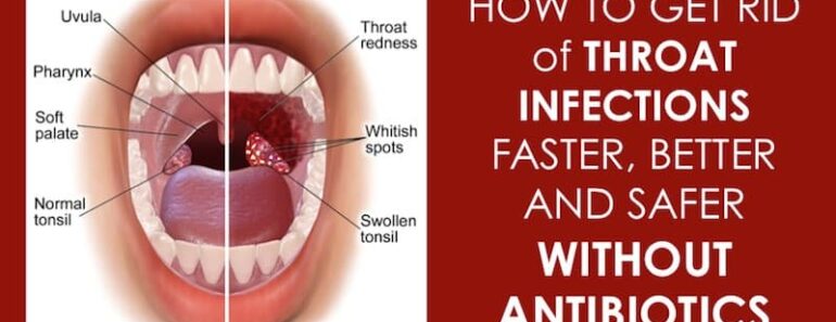12 Effective Natural Home Remedies To Treat A Strep Throat Infection